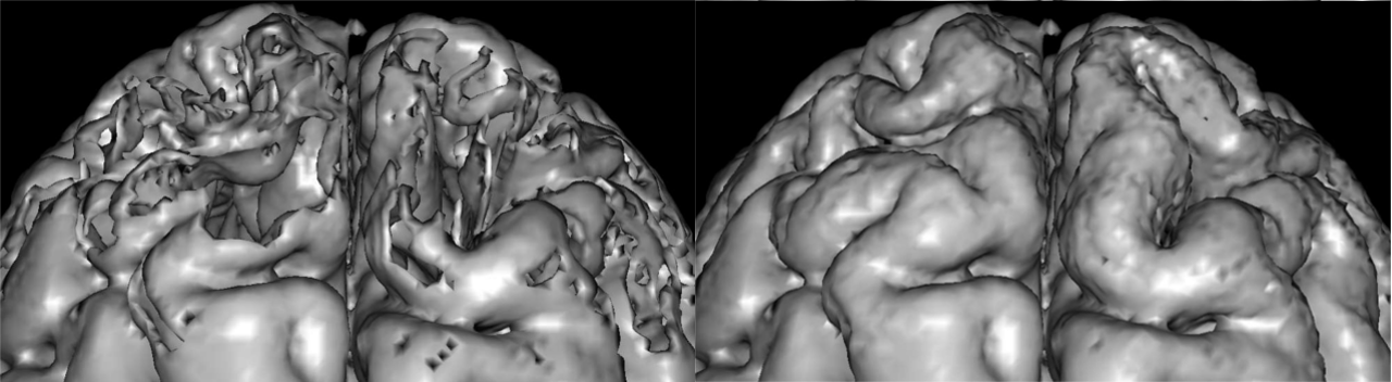 correcting and refining brain segmentation